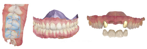 Intraoral-Scan-Beispiele